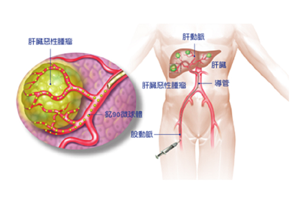 最新疱疹疗法,最新疱疹疗法，突破传统，开启治疗新篇章